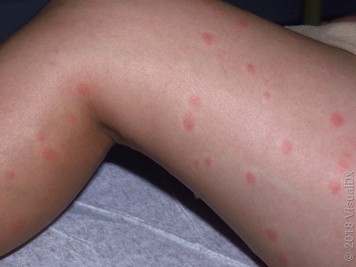 Close-up of swimmer’s itch on the leg. 