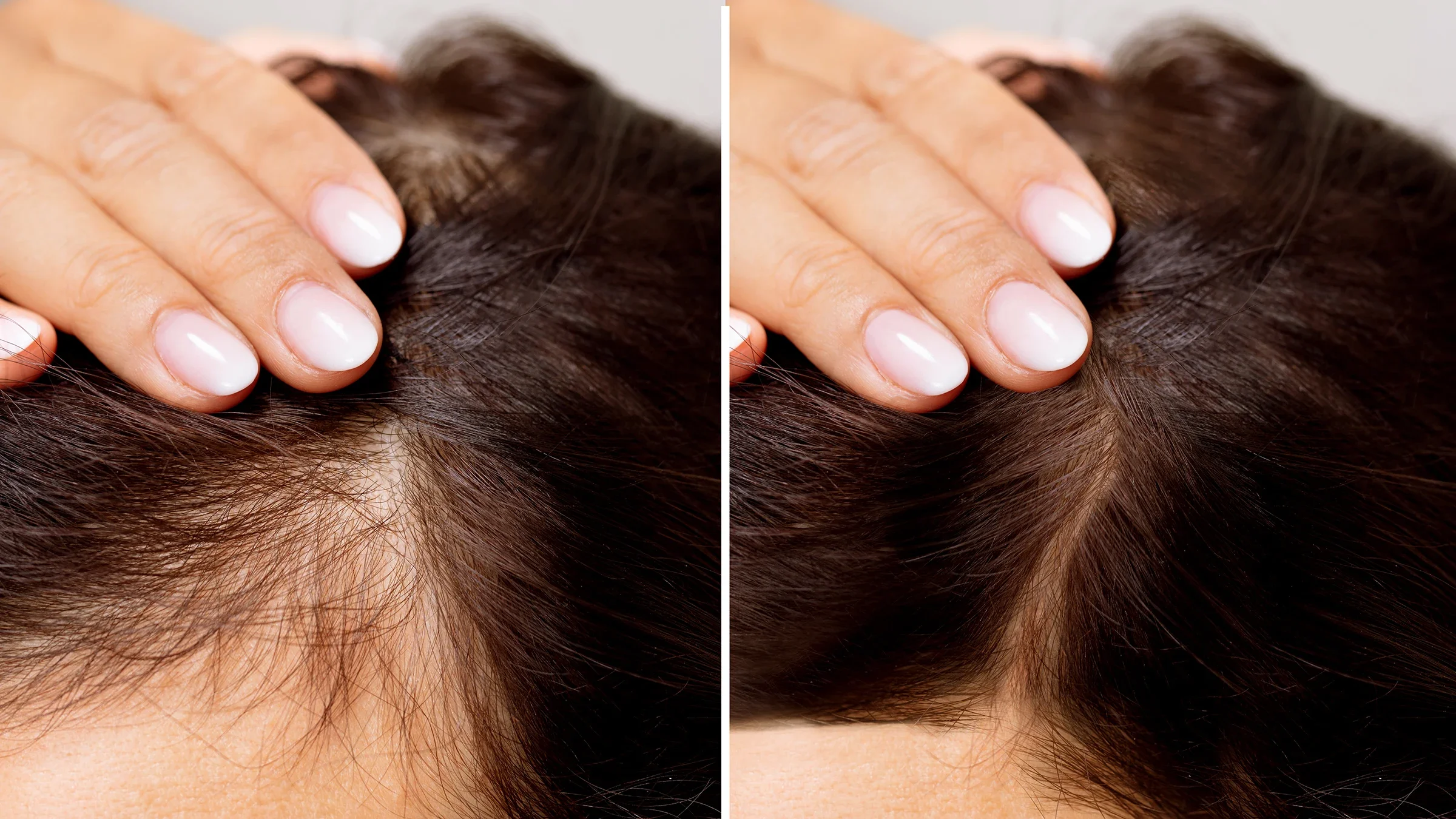 Close-up side by side before and after photos of hair loss and treatment.
AndreyPopov/iStock via Getty Images