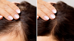 There are several hair-loss treatments available to men and women. From medications to supplements, learn what the best hair-loss treatment is for you.