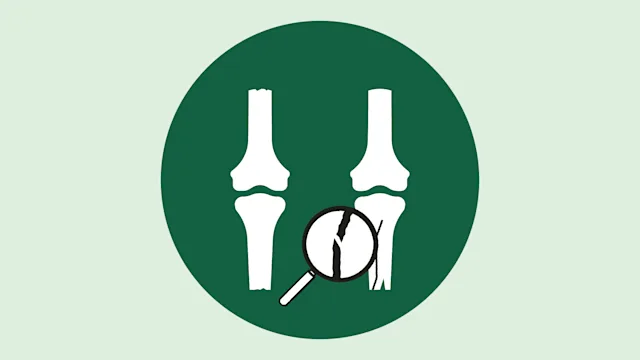 Musculoskeletal: quiz stress fracture-01