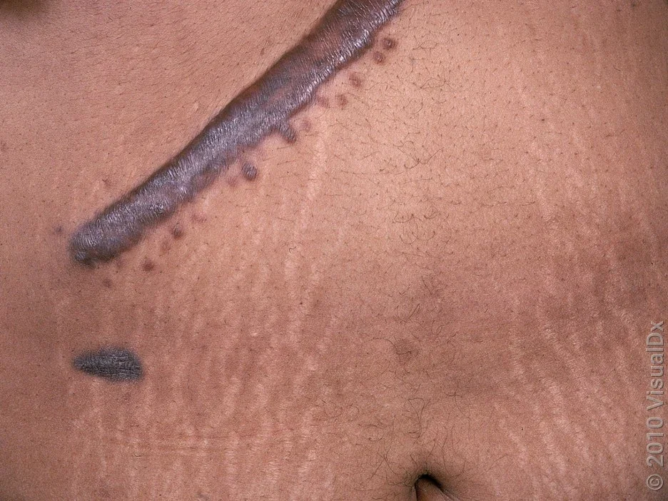 Close-up of a keloid from a surgical scar. 