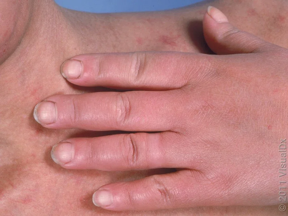 A close-up look at scleroderma on the fingers. 