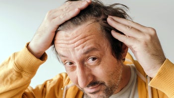 minoxidil-non-prescription: man concerned about hair loss 1446866727
