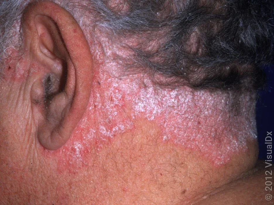 Pink skin patches covered in white scale in neck and scalp psoriasis. 
