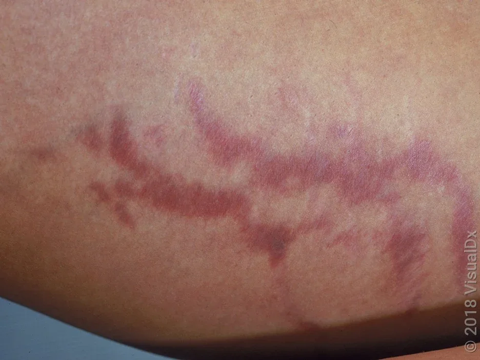Close-up of stretch marks on the inner thigh.