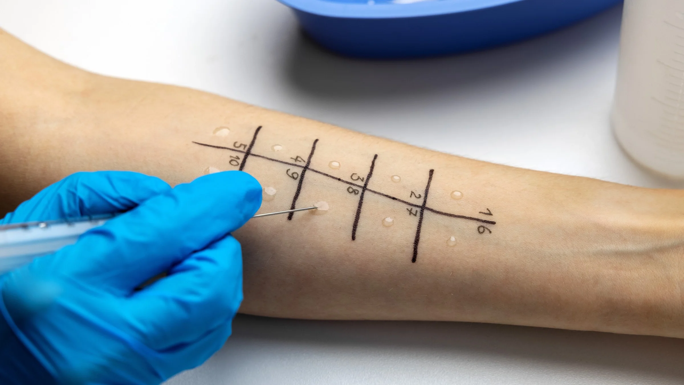 A close-up on a person's forearm doing a food allergy prick test.