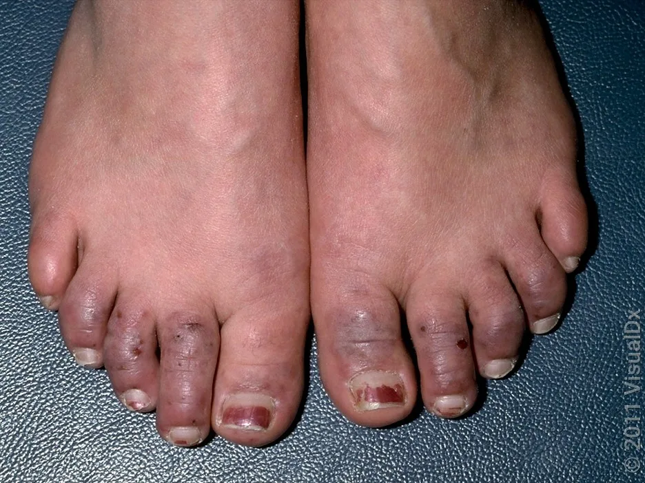 Close-up of Raynaud’s syndrome on the toes.
