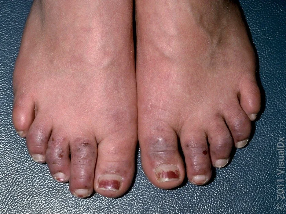 Close-up of Raynaud’s syndrome on the toes.