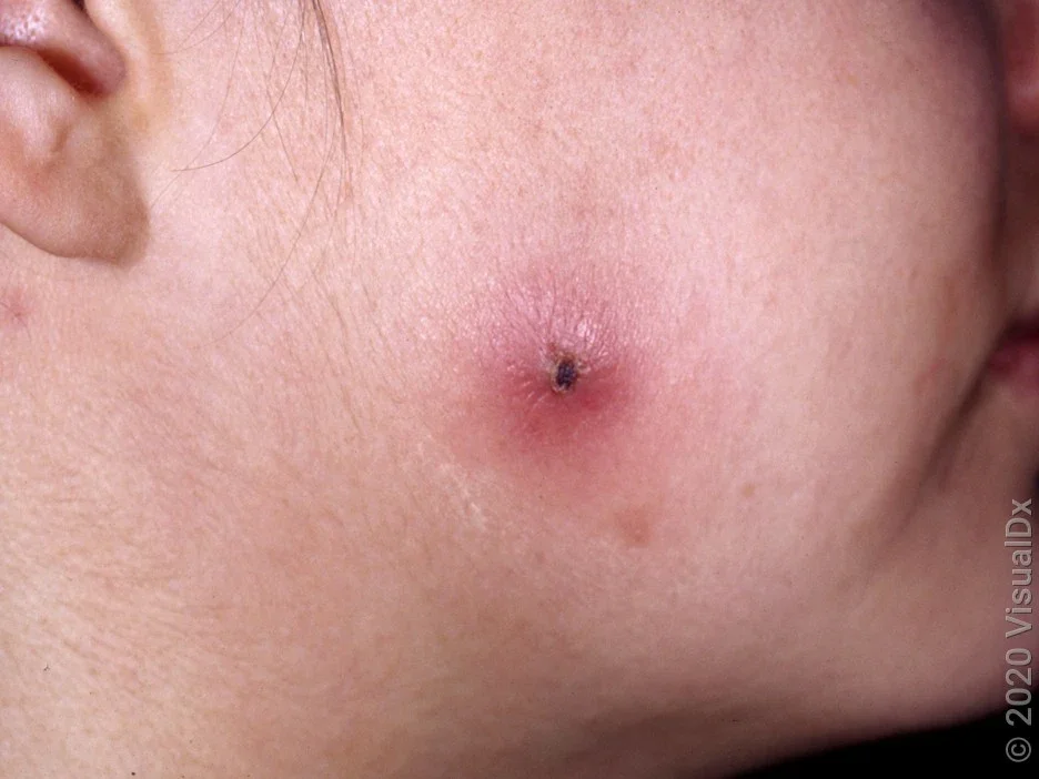 Close-up of the cheek with a crusty spider bite.