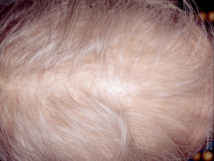 Close-up of hair thinning at the crown and a widening part. 