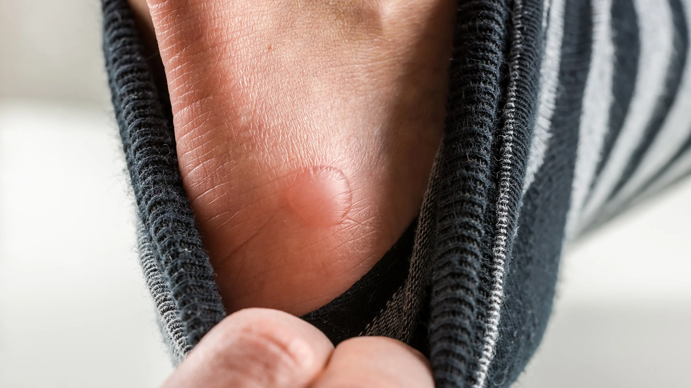 Close-up of a blister on the back of a heel