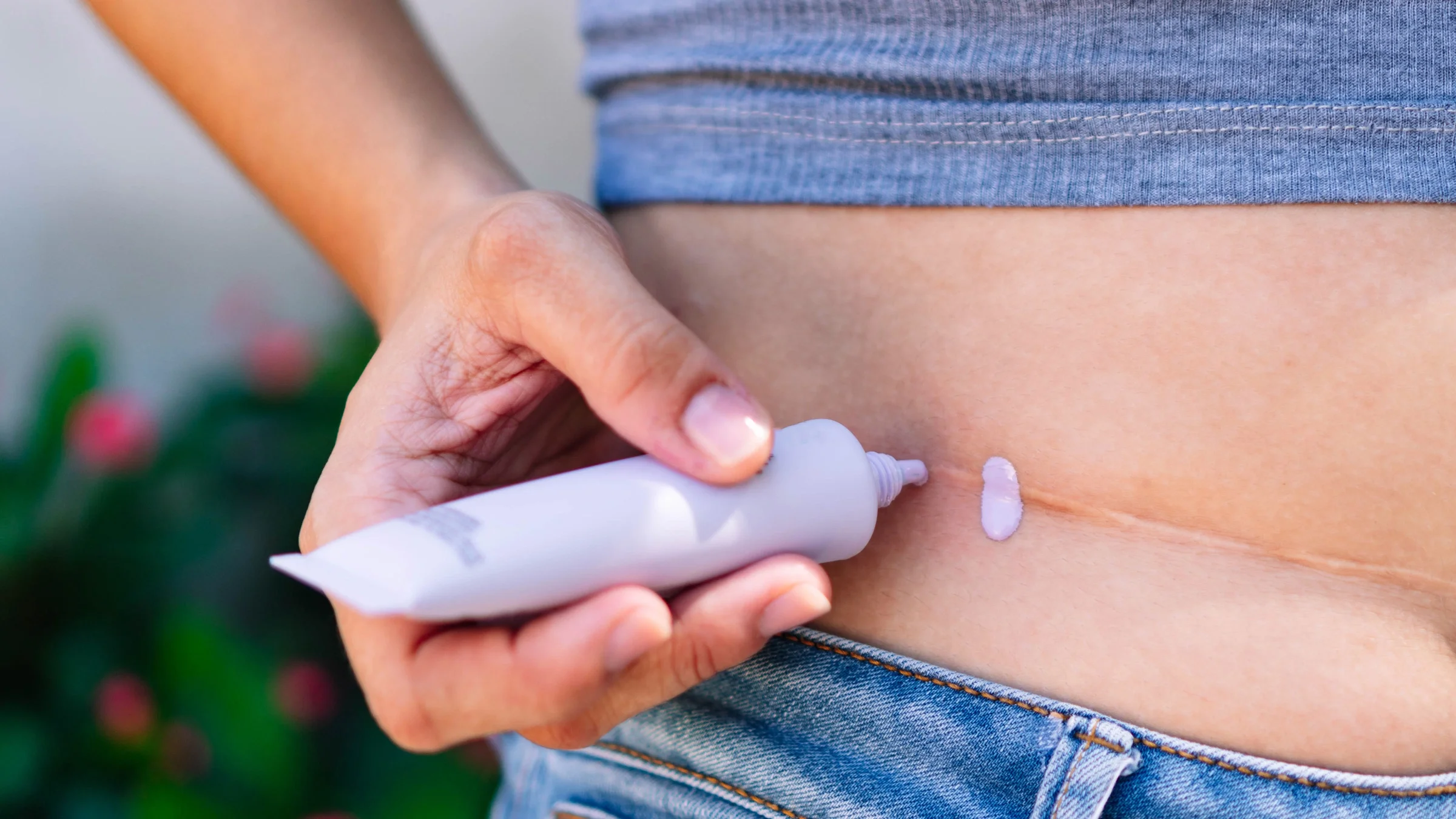 Cropped image of someone applying ointment on a scar.