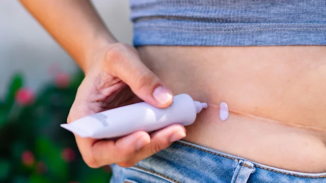 Dermatology: applying cream on scar 1295551635