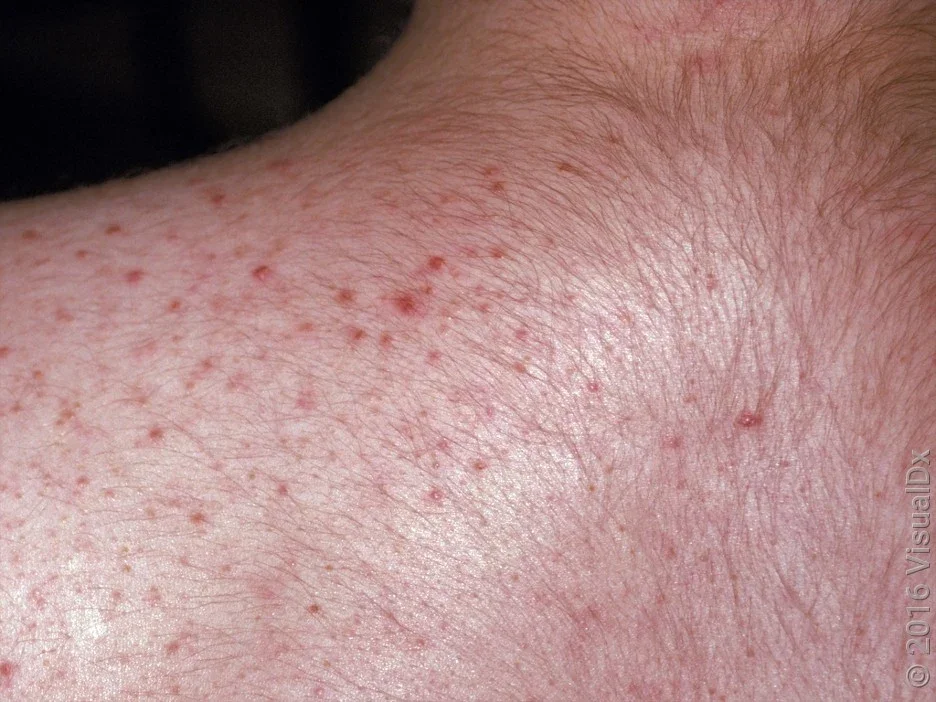 Close-up of fungal acne on the shoulder. 