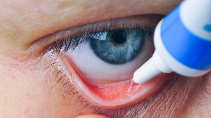 A person administers medicine into their eye.