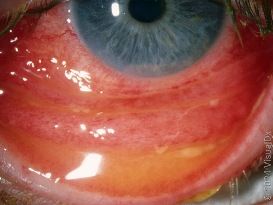 Conjunctivitis of the inner eyelid (conjunctiva) with discharge.