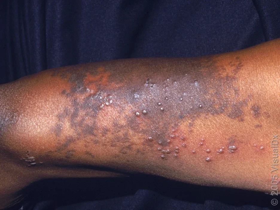 Close-up of the shingles rash on the arm in Black skin with brown patches.