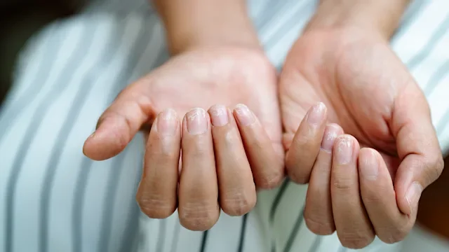 Psoriatic Arthritis Nail Symptoms: 8 Common Signs (With Pictures)