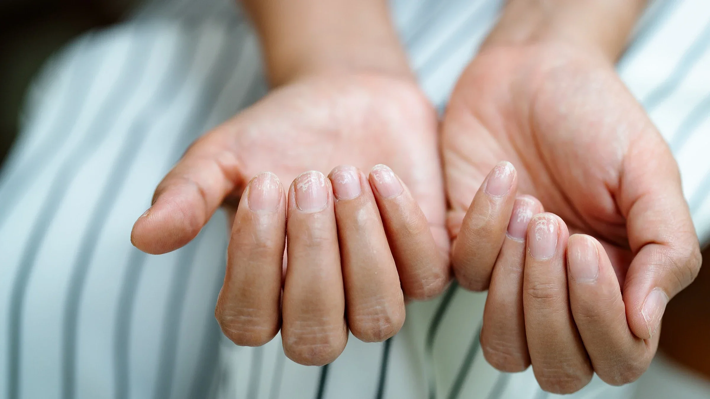 Close-up on a person's hands with white lined brittle fingernails.
PORNCHAI SODA/iStock via Getty Images