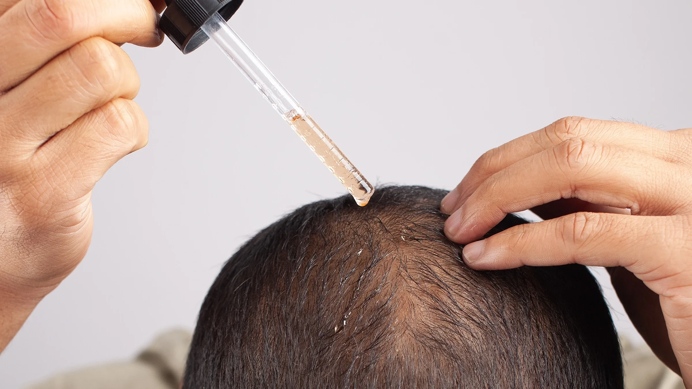 A person with thinning hair applies hair serum to their scalp, in close-up.