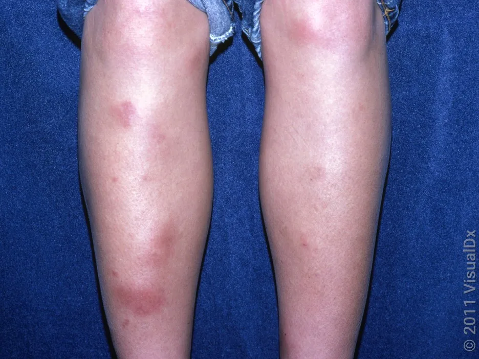 Erythema nodosum on the legs.