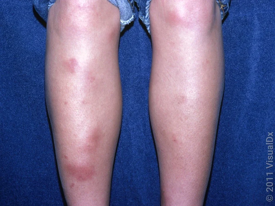 Erythema nodosum on the legs. 