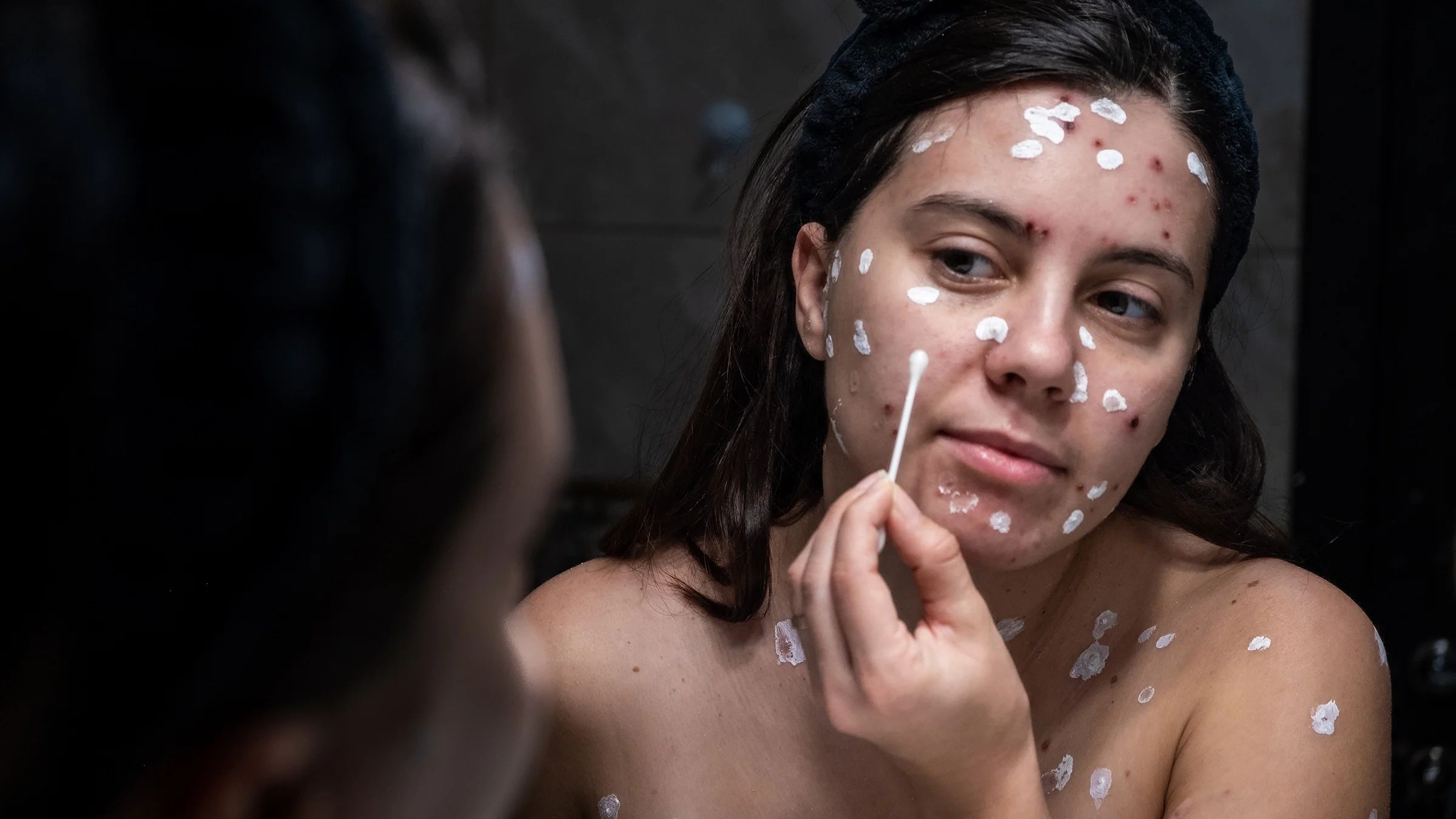 Woman with chickenpox applying cream in a bathroom mirror
