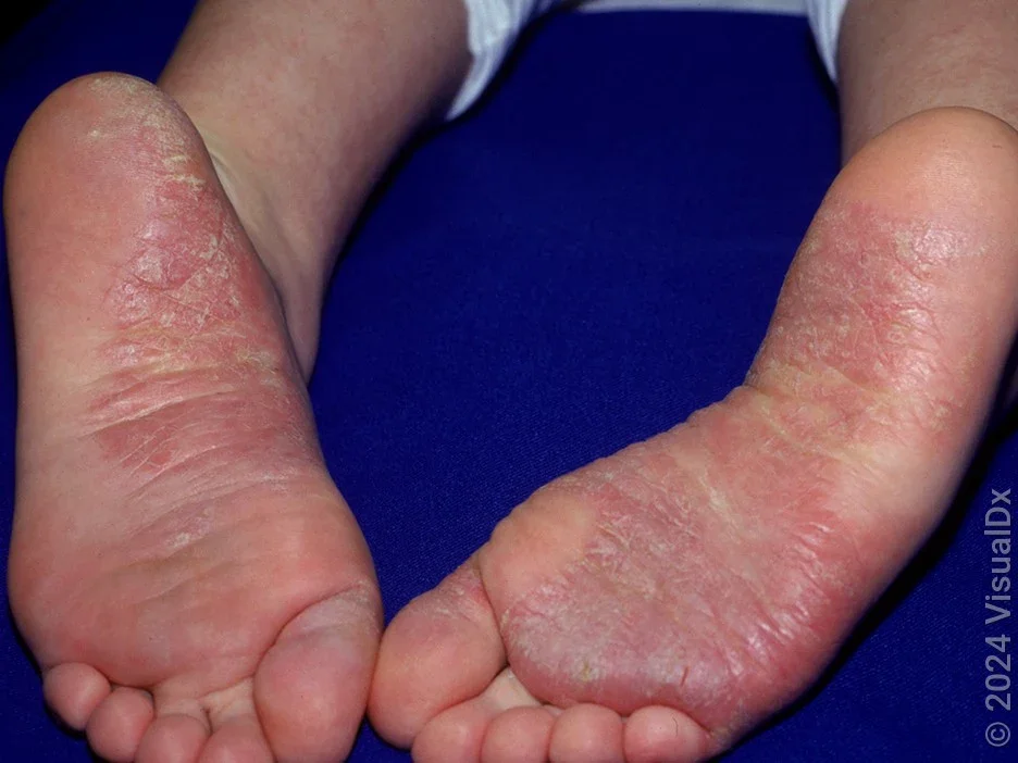 Close-up of the soles of the feet with red scaly patches from psoriasis. 