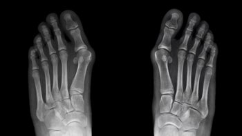 Health: Health insurance: xray bunions-1181999741