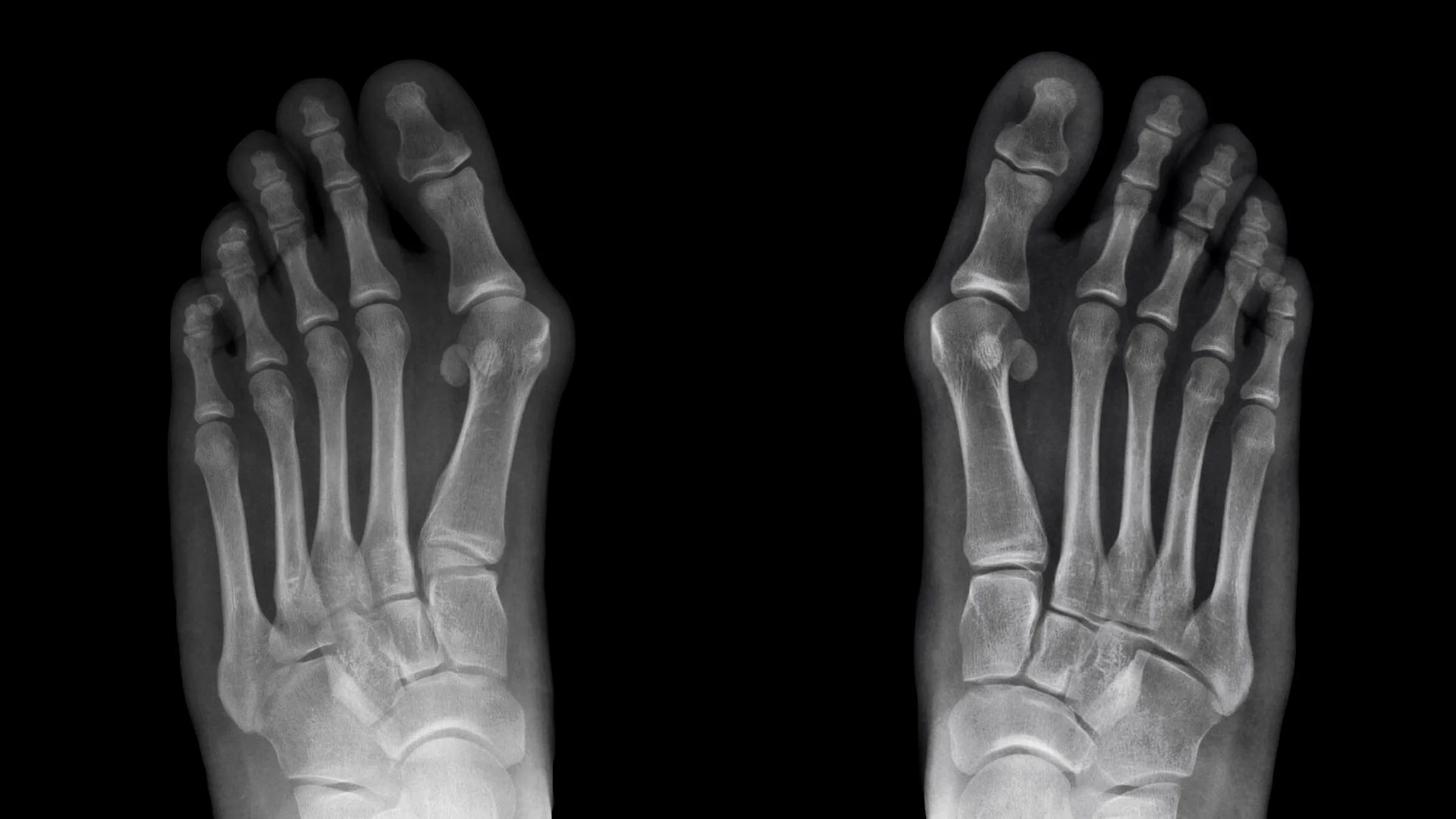 Black-and-white X-ray of bunions on feet.