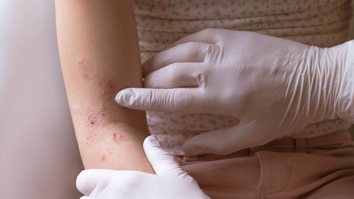 Close-up of a doctor wearing medical gloves to examine a rash on a child's arm.