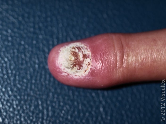 Close-up of a nail that looks crumbly (nail psoriasis). 