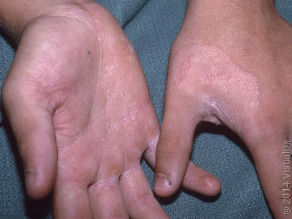 Fungal dry patches on the palm and back of the hand. 