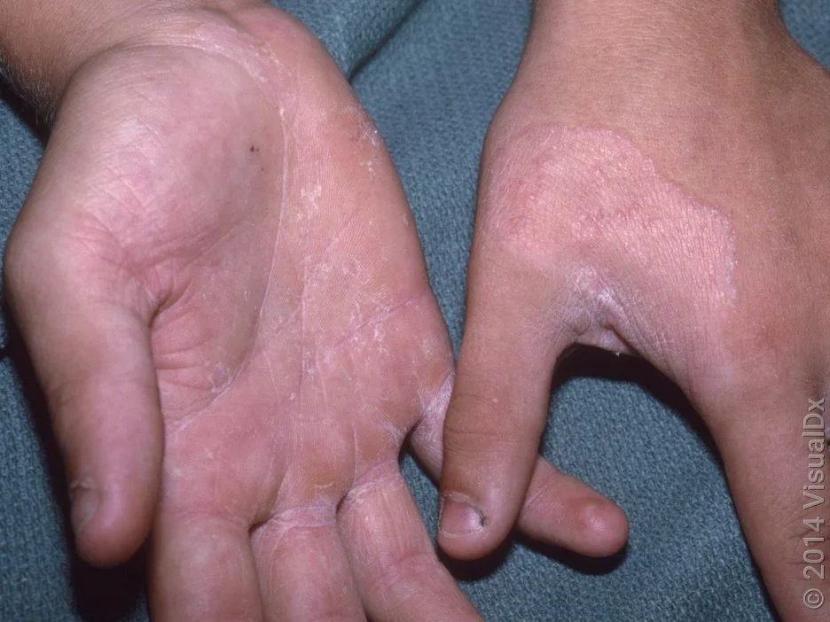 Fungal dry patches on the palm and back of the hand. 