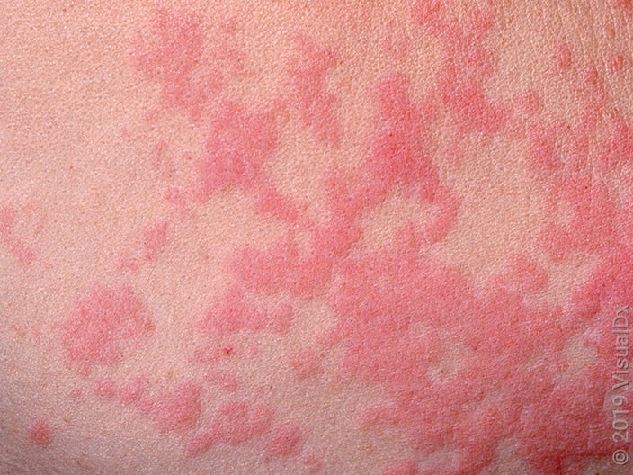 Reddish hives on fairer skin. 