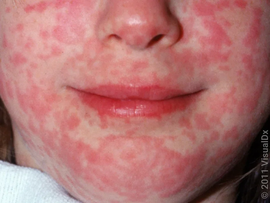 Close-up of many red spots on the face caused by measles.