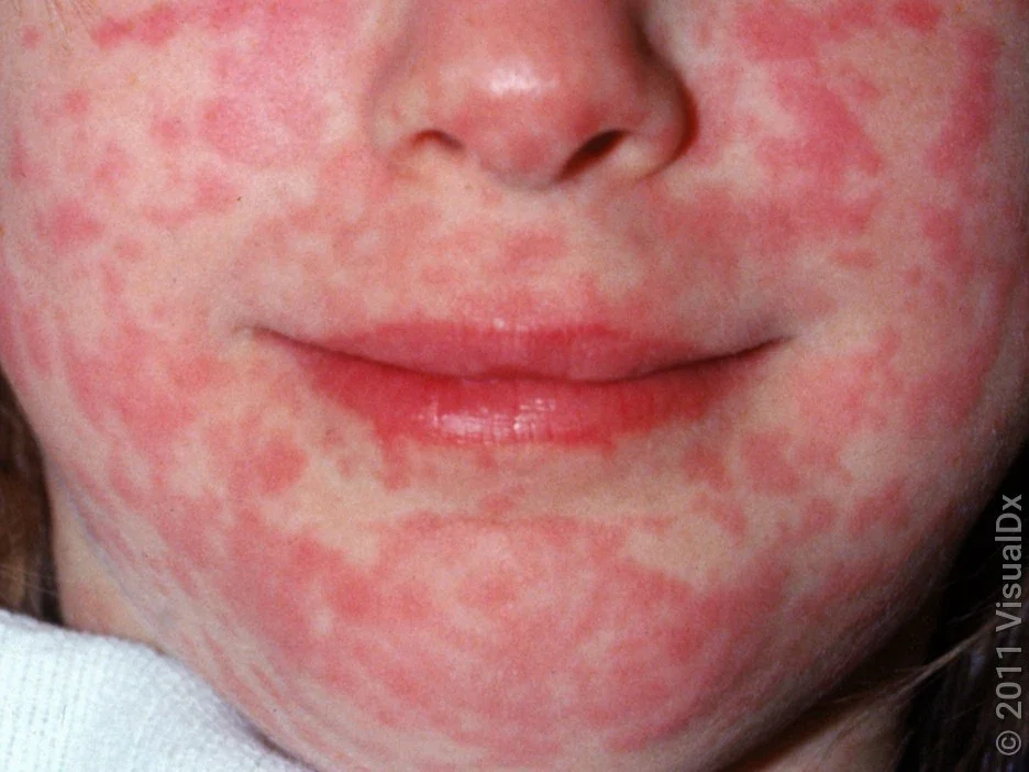 Close-up of many red spots on the face caused by measles. 