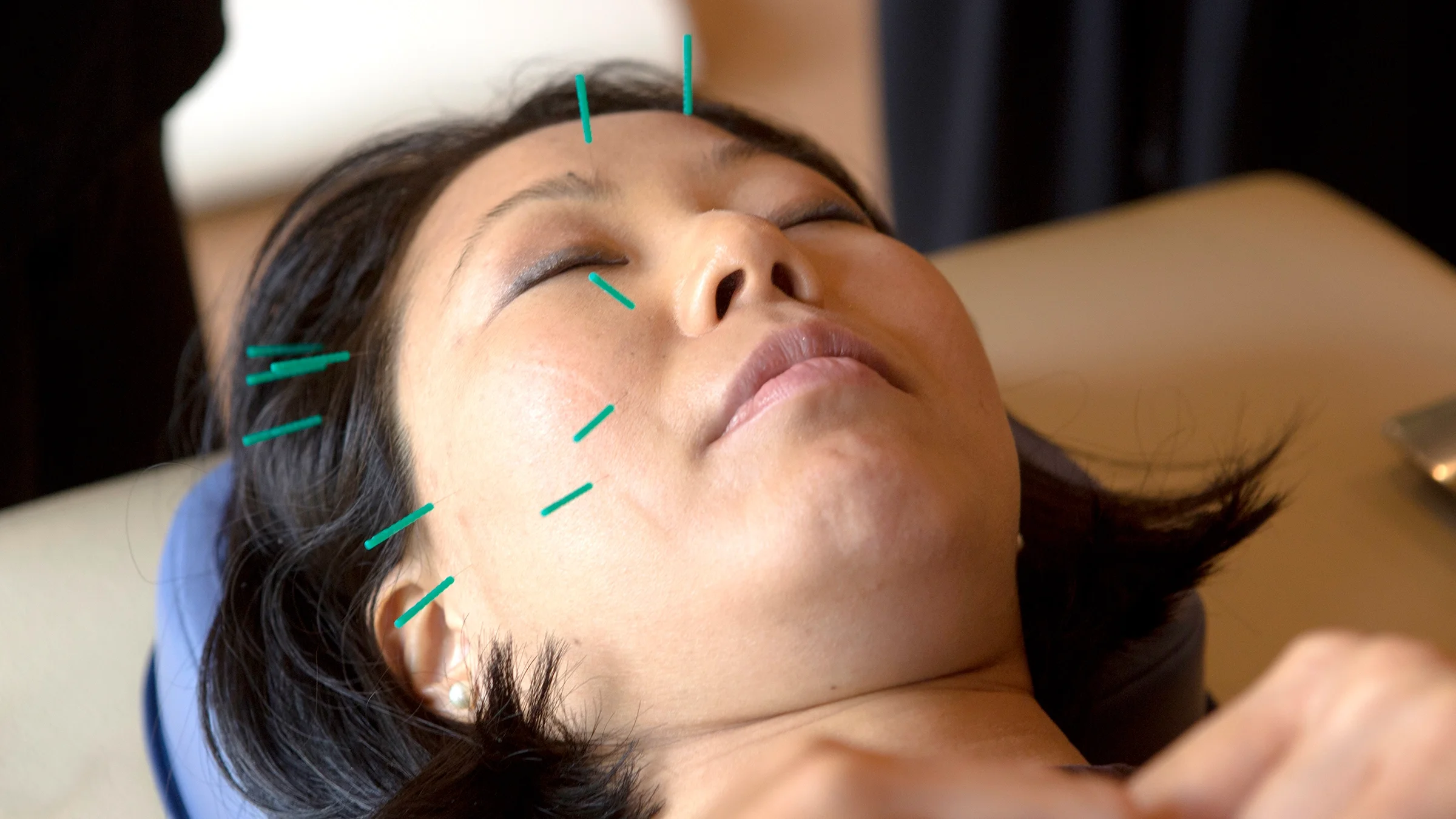Close-up on a woman having a facial acupuncture treatment done.