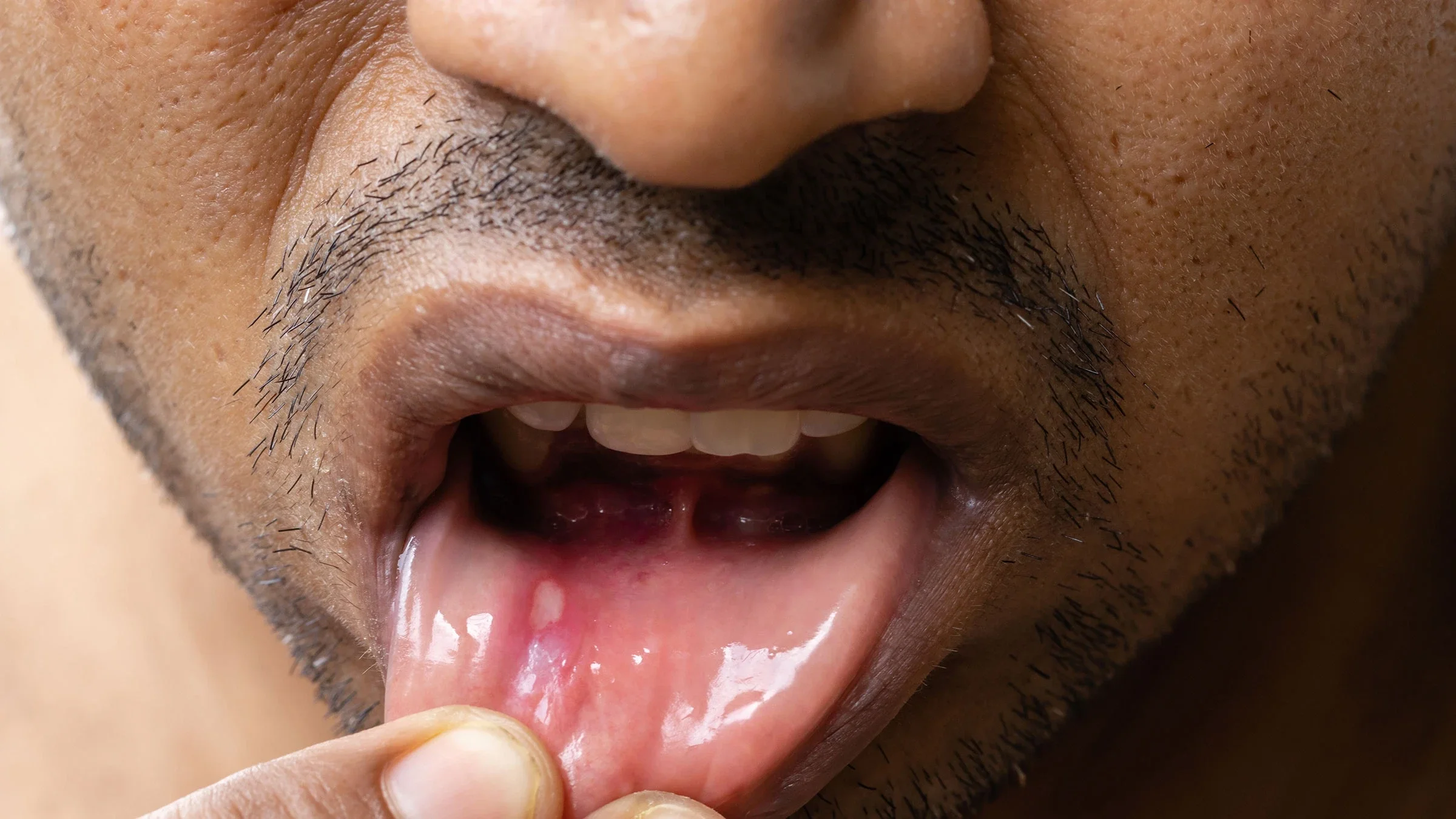 Close-up of a man with a canker sore.