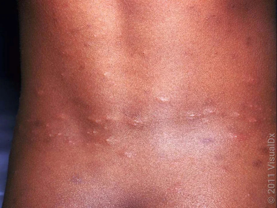 Close-up of the lower back with many violet and brown bumps and patches from flea bites.