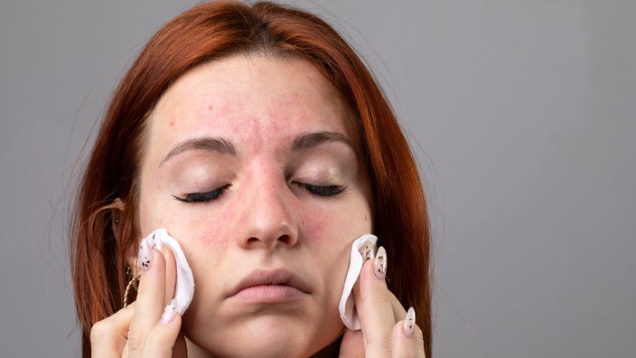A young woman has red bumps on her face. Acne can cause facial skin bumps, but there are many possible causes.