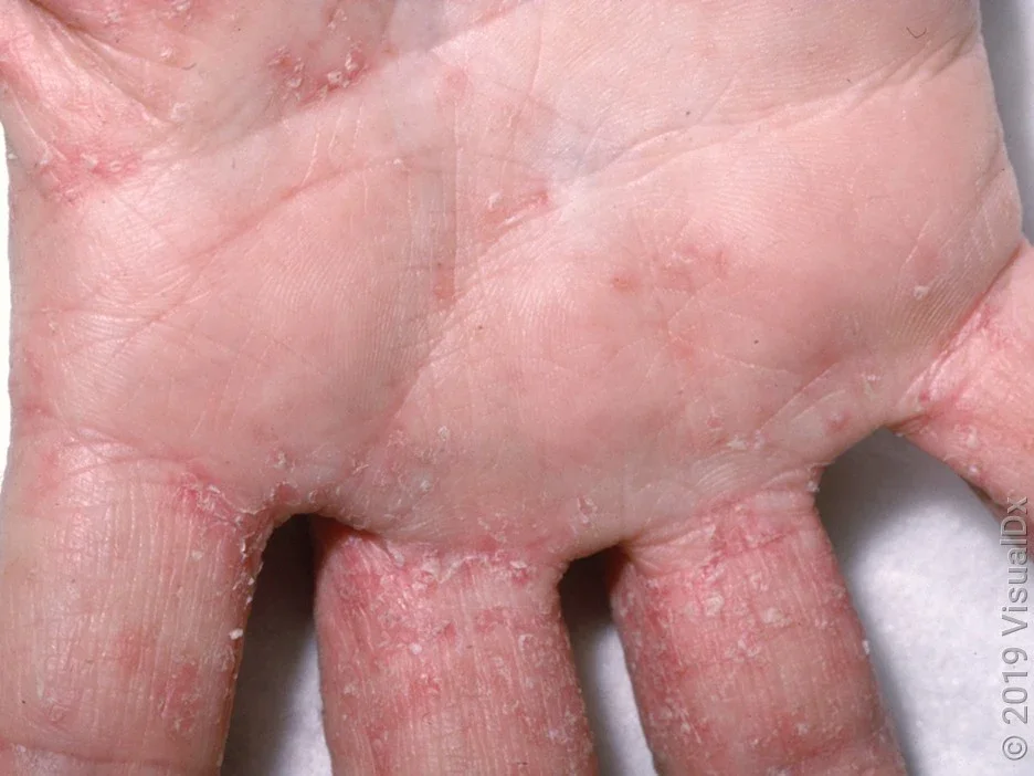 The palm and fingers of a hand with many tiny crusty pink bumps.