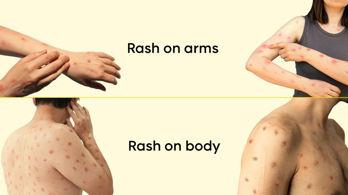 Four different examples of monkeypox rashes on people. They are separated by “Rash on Arms,” top row, and “Rash on Body,” bottom row. The background is a light yellow and there is a bright yellow divider line separating the rows of images. 