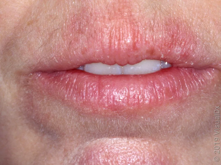 Close-up of dry, chapped lips (cheilitis) on lighter skin.
