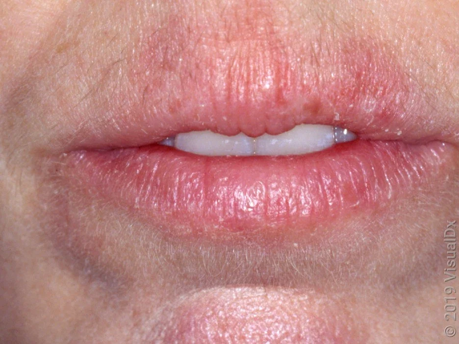 Close-up of dry, chapped lips (cheilitis) on lighter skin. 