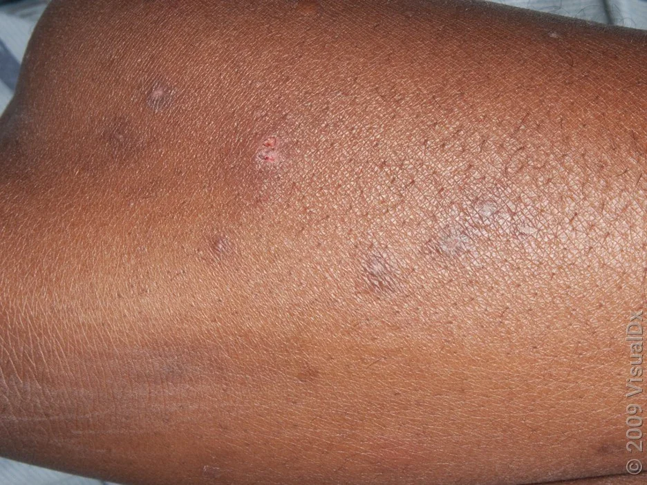 Close-up of a leg with brown bumps showing what bedbug bites look like.