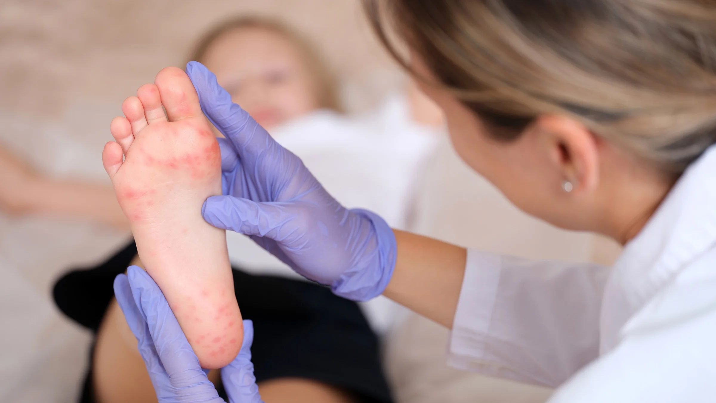 A healthcare provider is examining a rash on a child's foot.