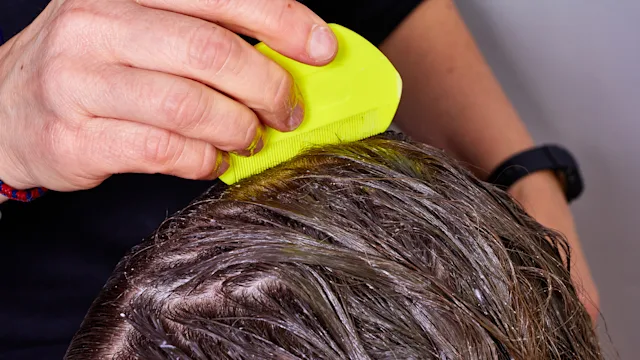 hair: checking wet hair for lice 504885866
