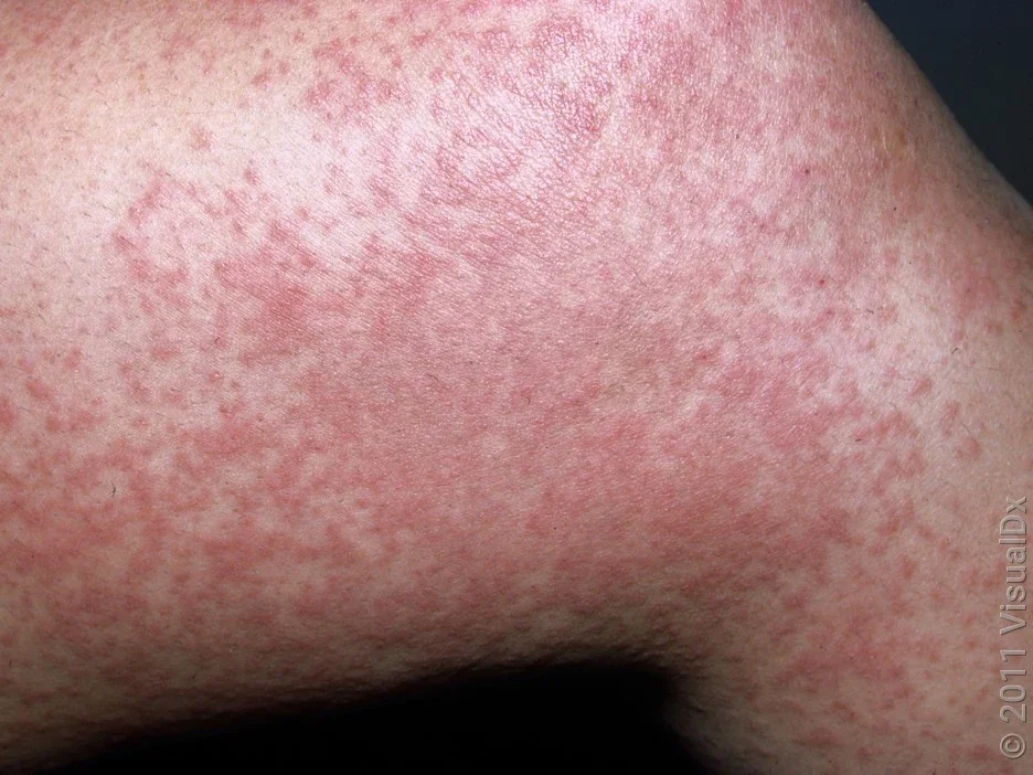 An antibiotic drug eruption rash on the leg. 