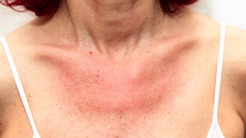 Health: Allergies: redness on chest-482265367